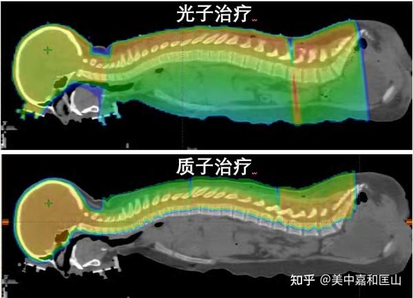 揭秘肿瘤治疗新利器——盘点质子放射治疗的三大优势 - 知乎