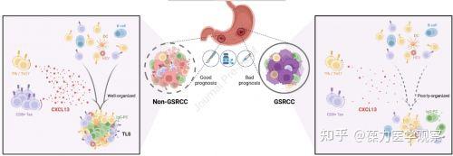 Gastroenterology | 发现胃印戒细胞癌高度恶性的潜在机理 - 知乎