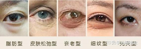 今天给大家介绍的是水剥离祛眼袋,任何部位的肌肤都是分为四层的,水