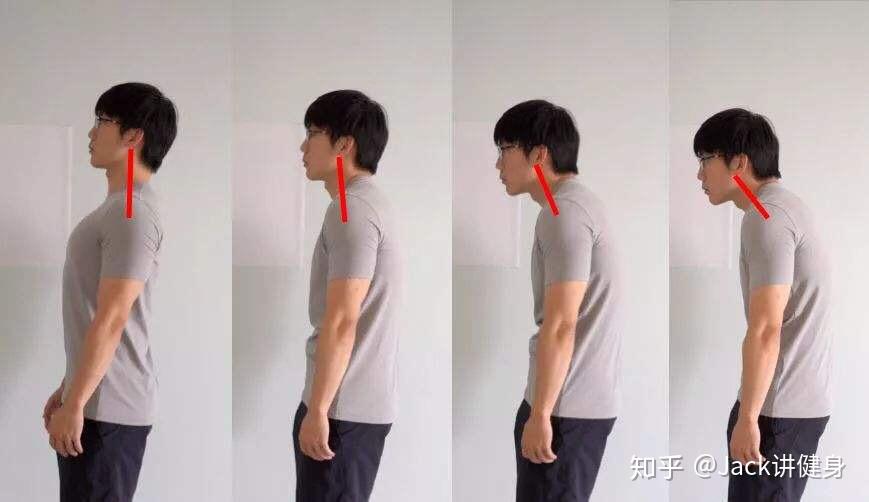 驼背和脊柱侧弯的区别在哪儿纠正方法有什么不一样吗