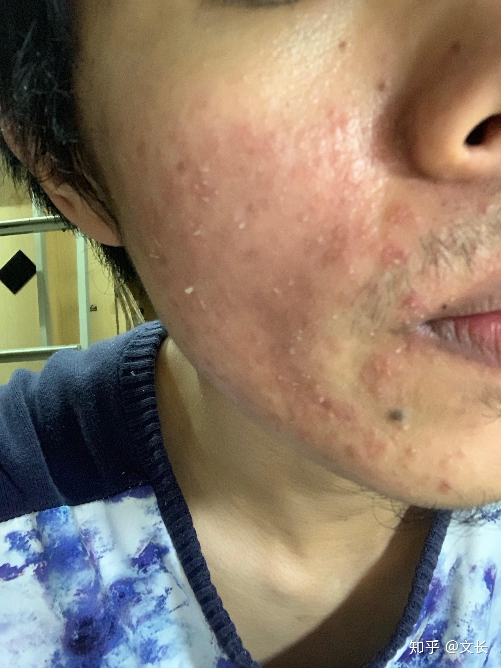 使用阿达帕林后,皮肤非常干燥脱皮,灼烧疼痛,而且脸特别红? - 知乎