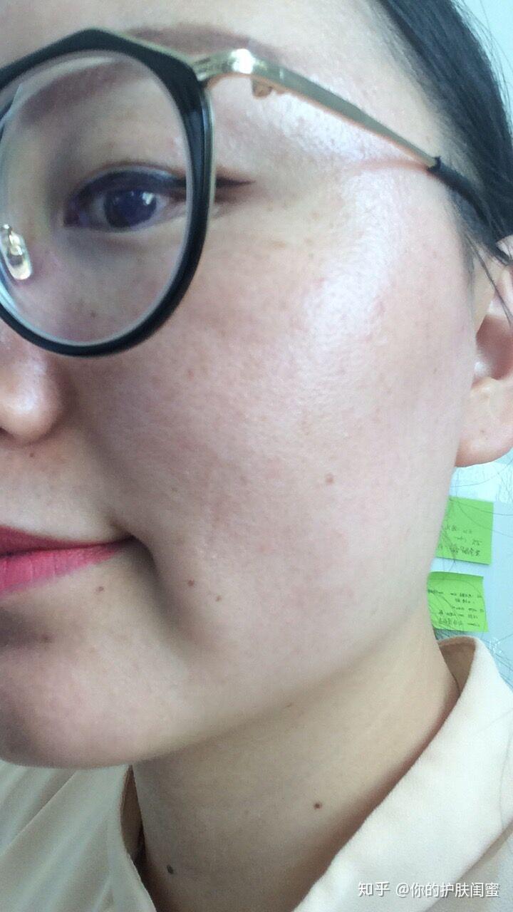 皮肤脆弱用什么产品能彻底变好用真实案例为你解答