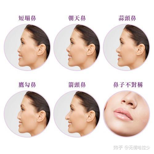 朝天鼻、鼻孔外露你中招了吗? - 知乎