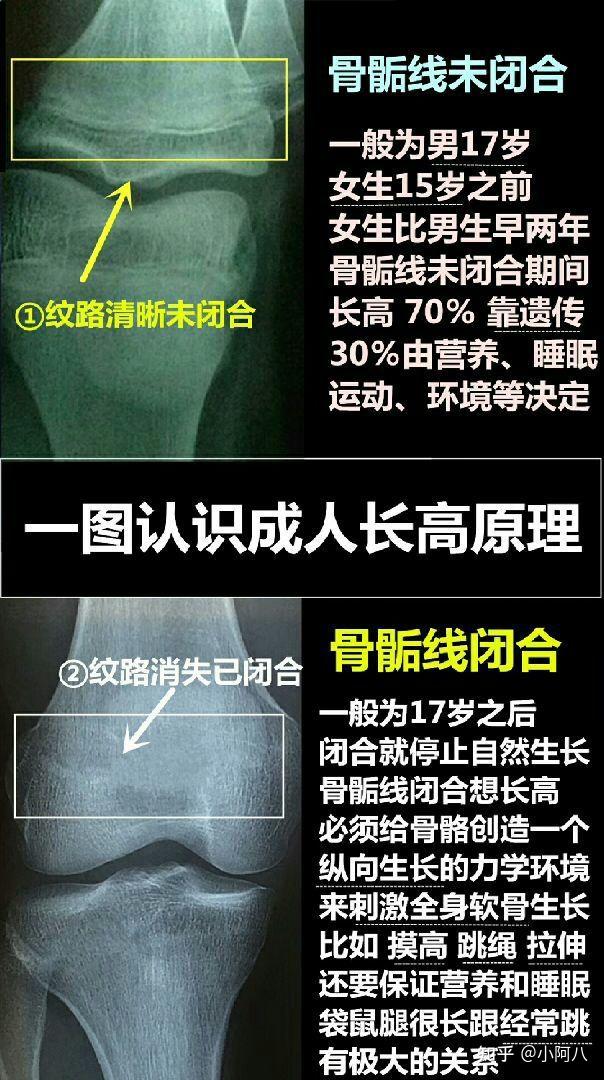 成人长高的原理（骨微裂）适合骨骼闭合的成年人 - 知乎