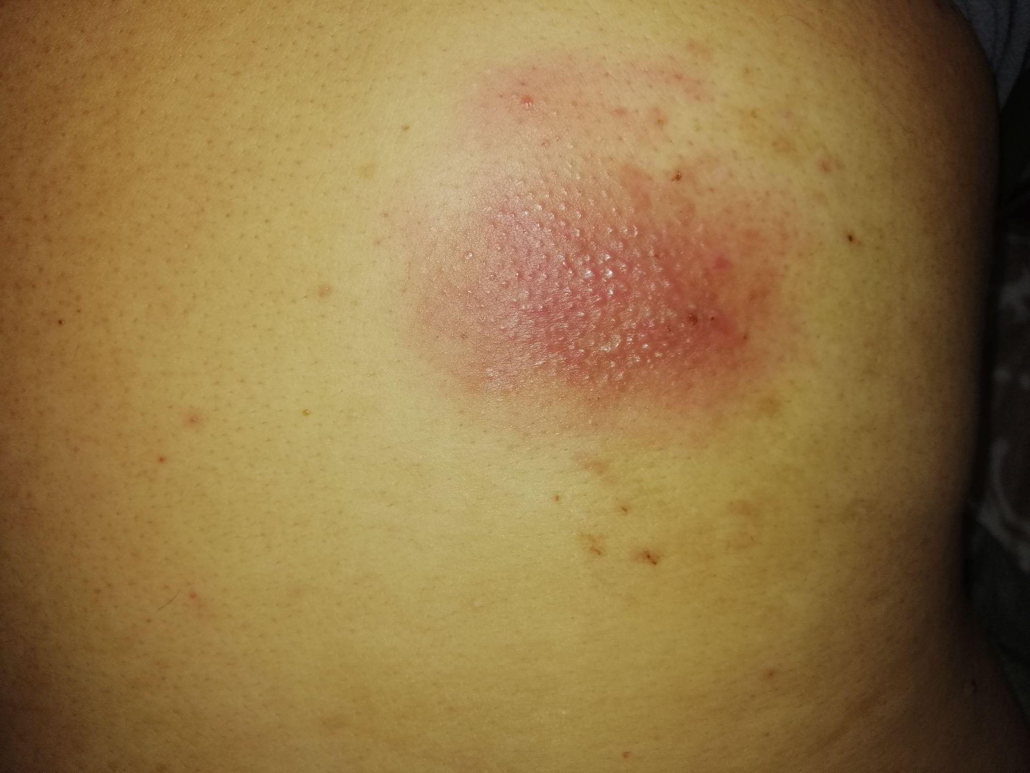 人体的火疖子 (化脓性毛囊及毛囊深部周围组织的感染) 能有多大?