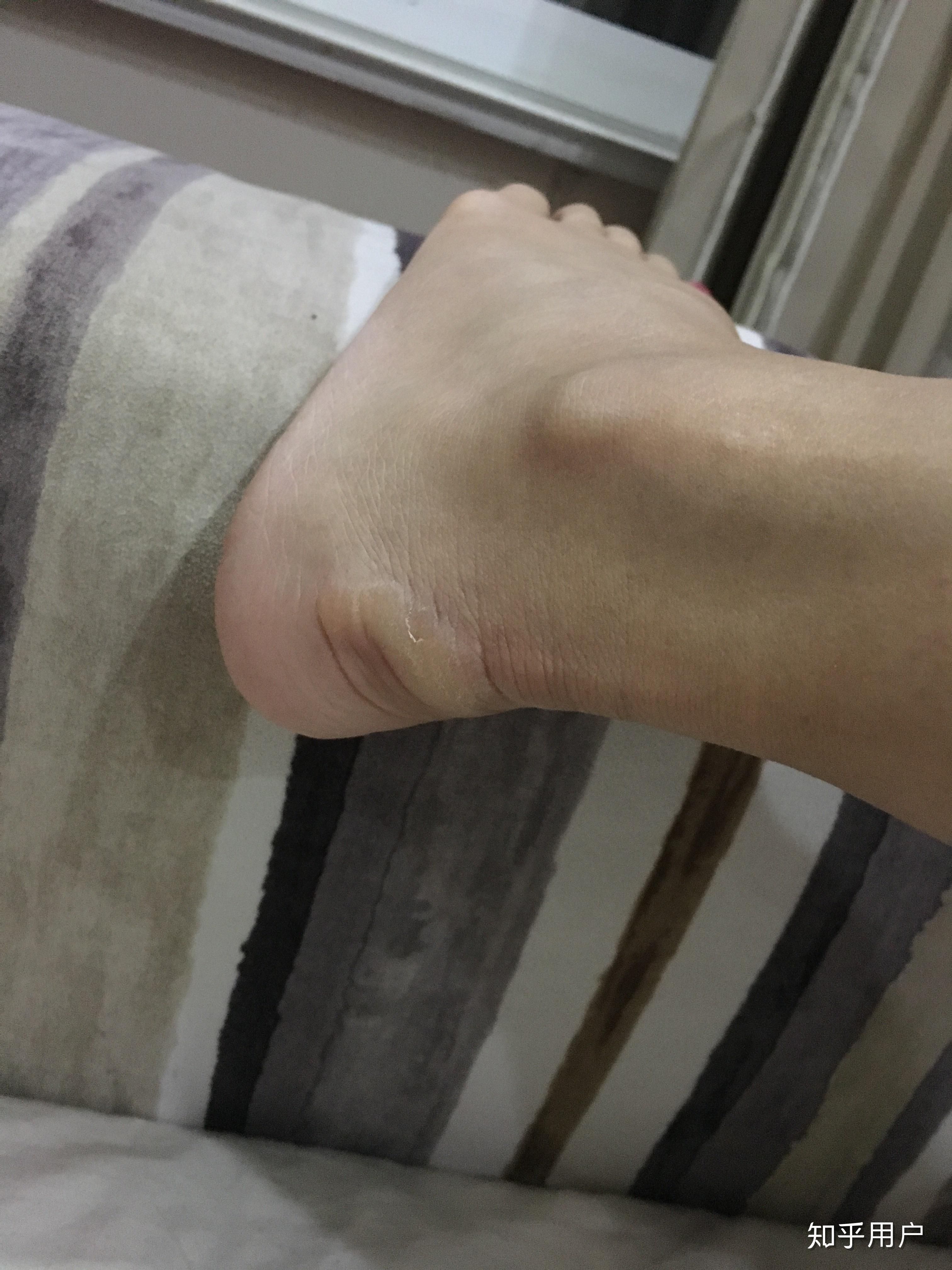 没有脚后跟是一种怎样的体验怎么解决