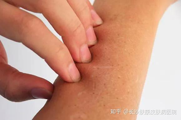 胸部鸡皮肤色素沉着(鸡皮肤色素沉淀在皮肤内怎么有效消除)