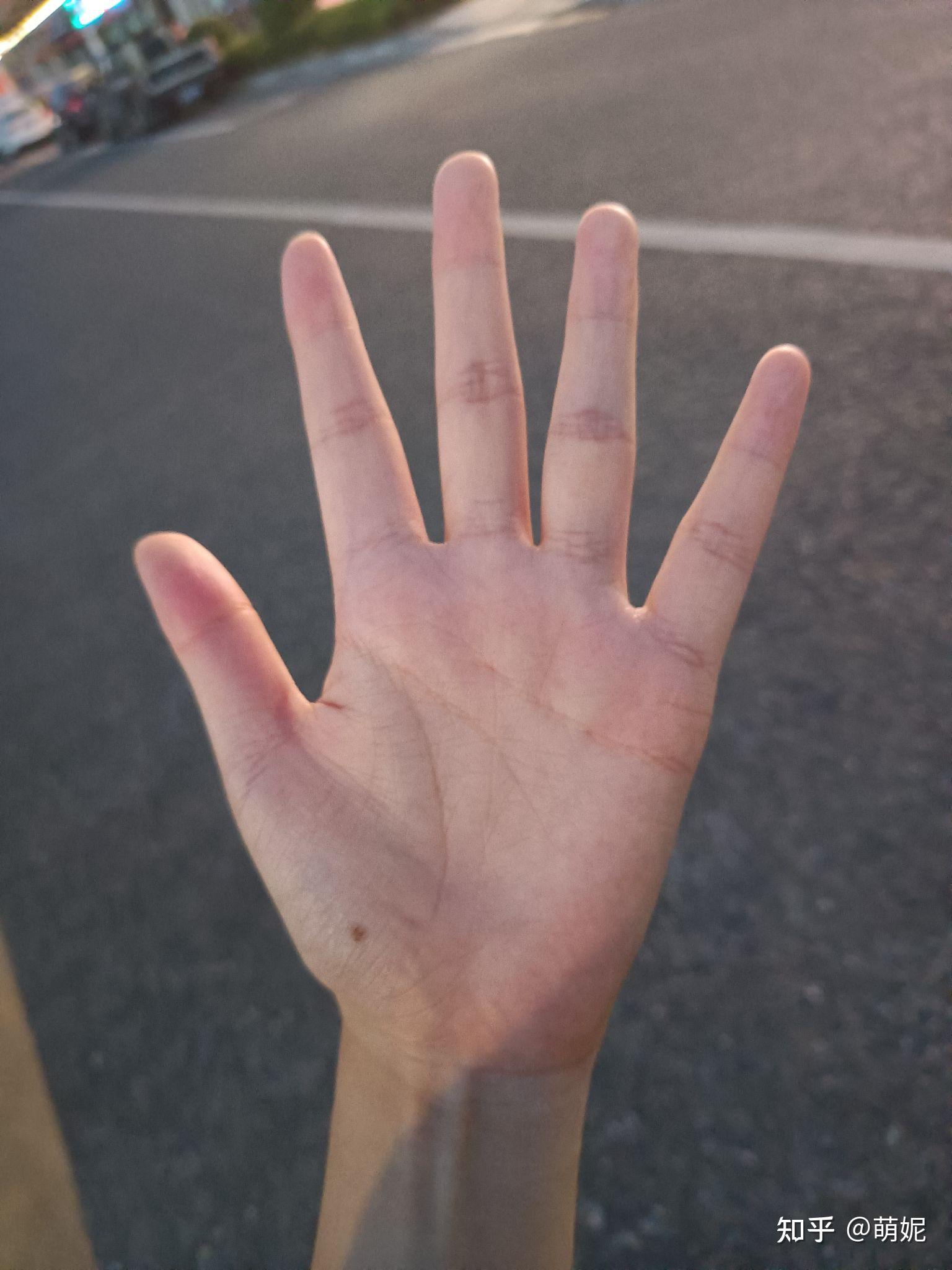 左手大鱼际有颗痣