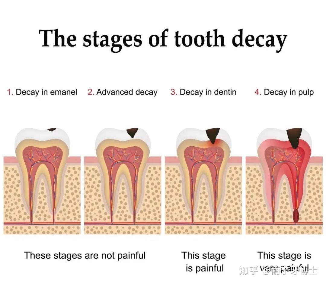 补牙让牙洞越来越大？浅龋不用补？ 知乎