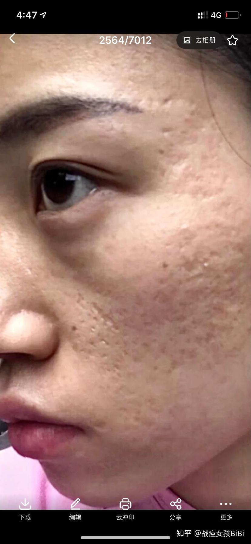 2次点阵激光修复50痘坑经验分享