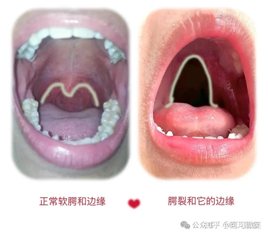 不怎么明显”的腭裂，要做手术吗？ - 知乎