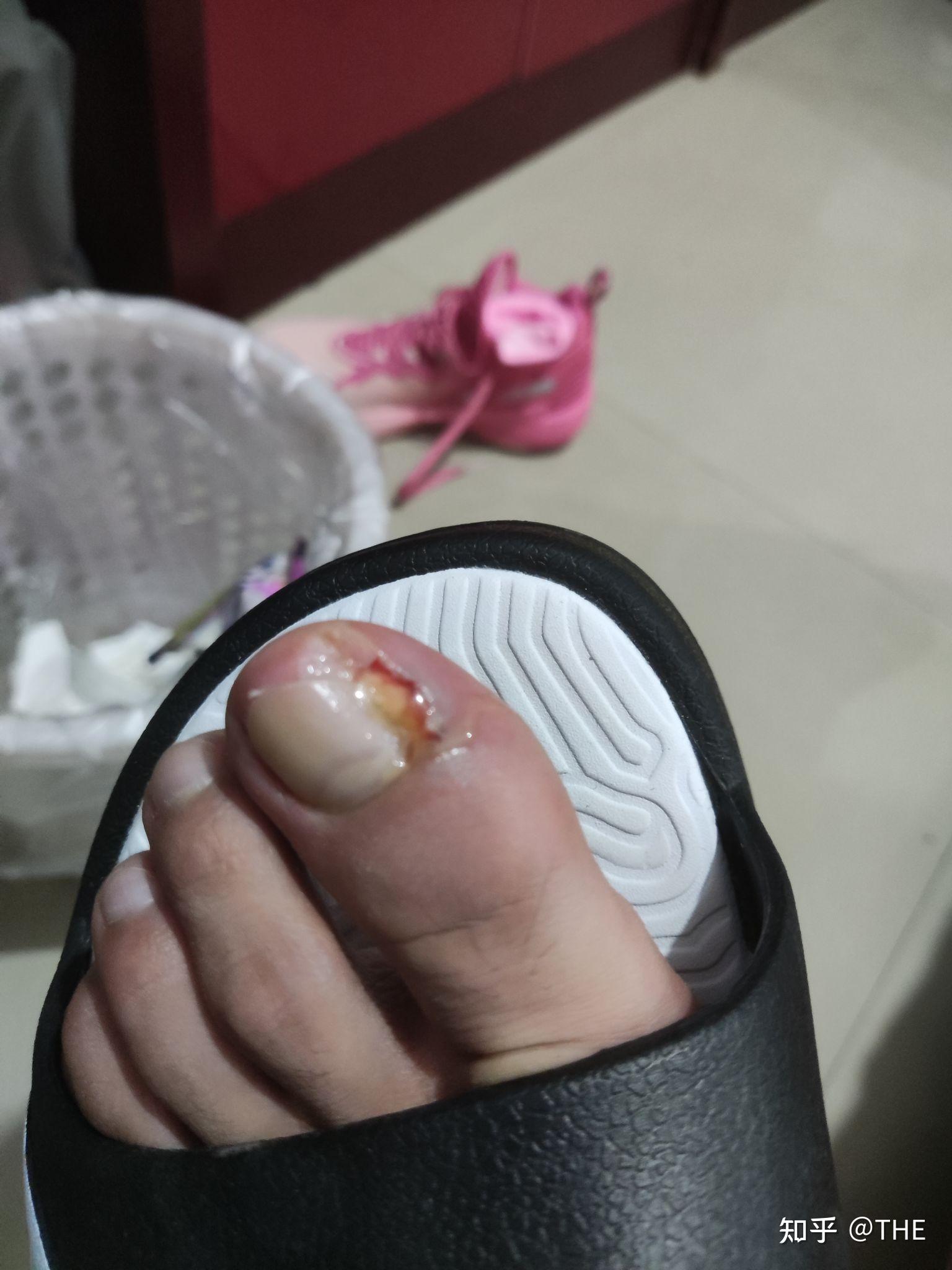 我的大脚趾头肿了很突然就是挠怪舒服的还有知道怎么的吗?