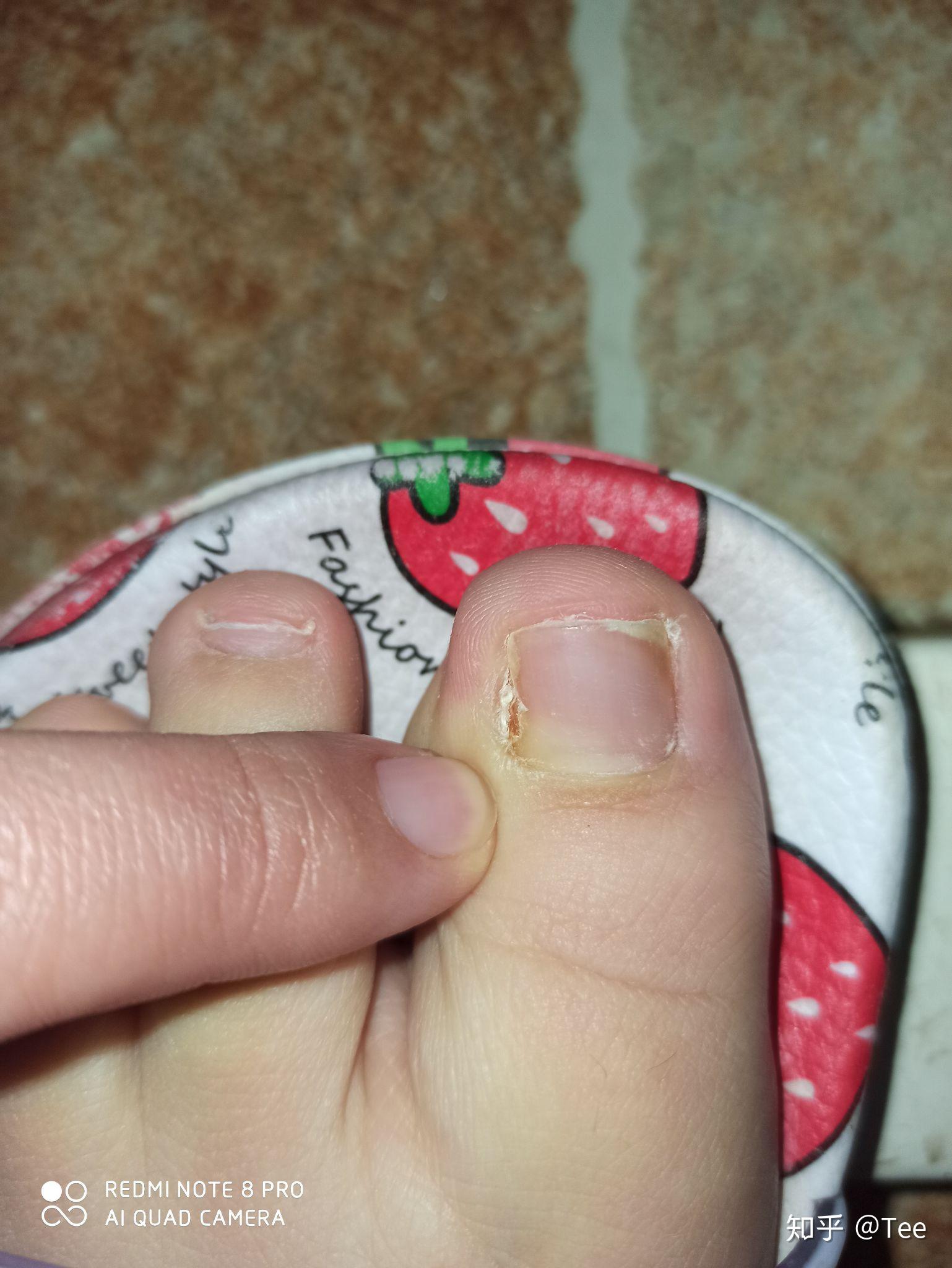 嵌甲,甲沟炎(附图)? - 知乎