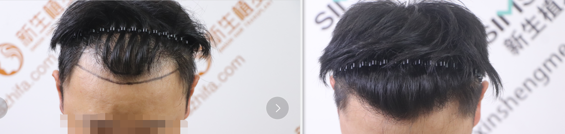 想要植发效果好，这3点缺一不可！ - 知乎
