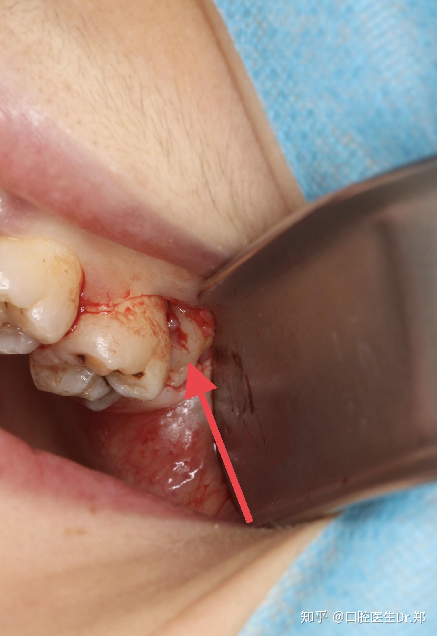 郑州智齿微创拔牙智齿到底拔还是不拔