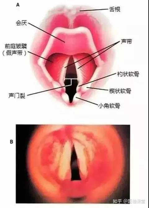 喉腔前庭裂图片