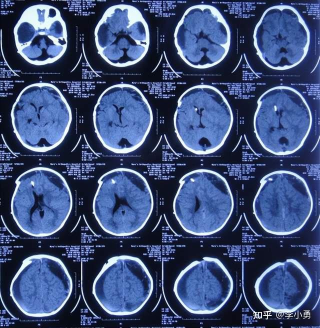 6月内4家医院双颞巨大蛛网膜囊肿术后变硬脑膜下积液反复引流又成脑