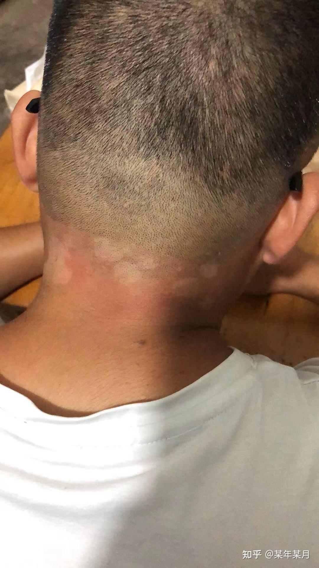 脖子后长了几团白色的是什么?