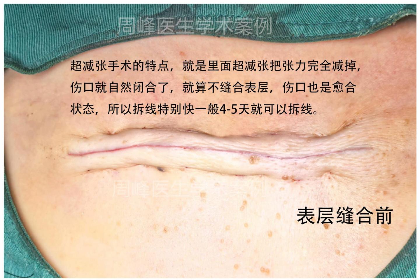 超减张精细缝合术 - 知乎