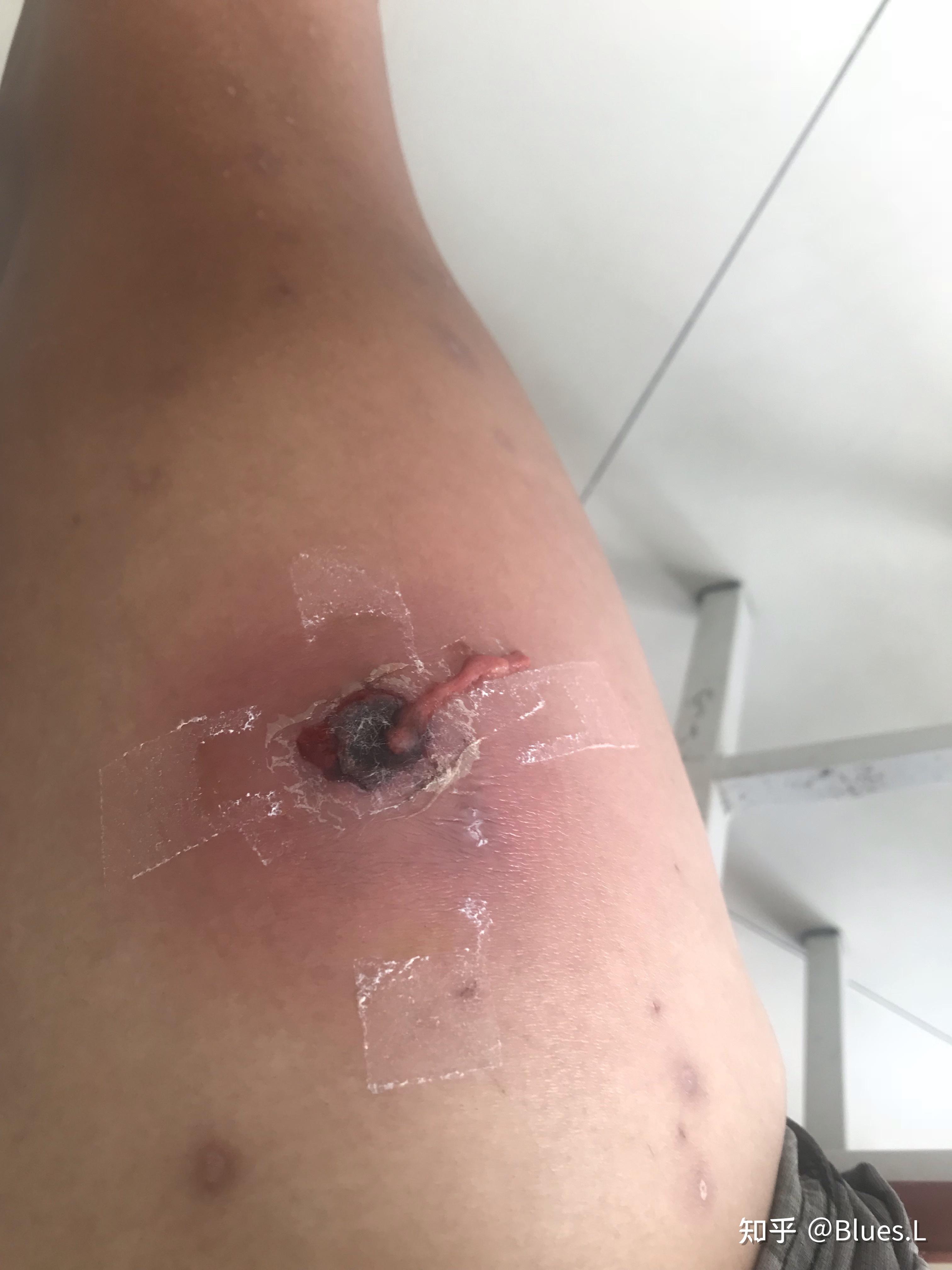 人体的火疖子 (化脓性毛囊及毛囊深部周围组织的感染) 能有多大?