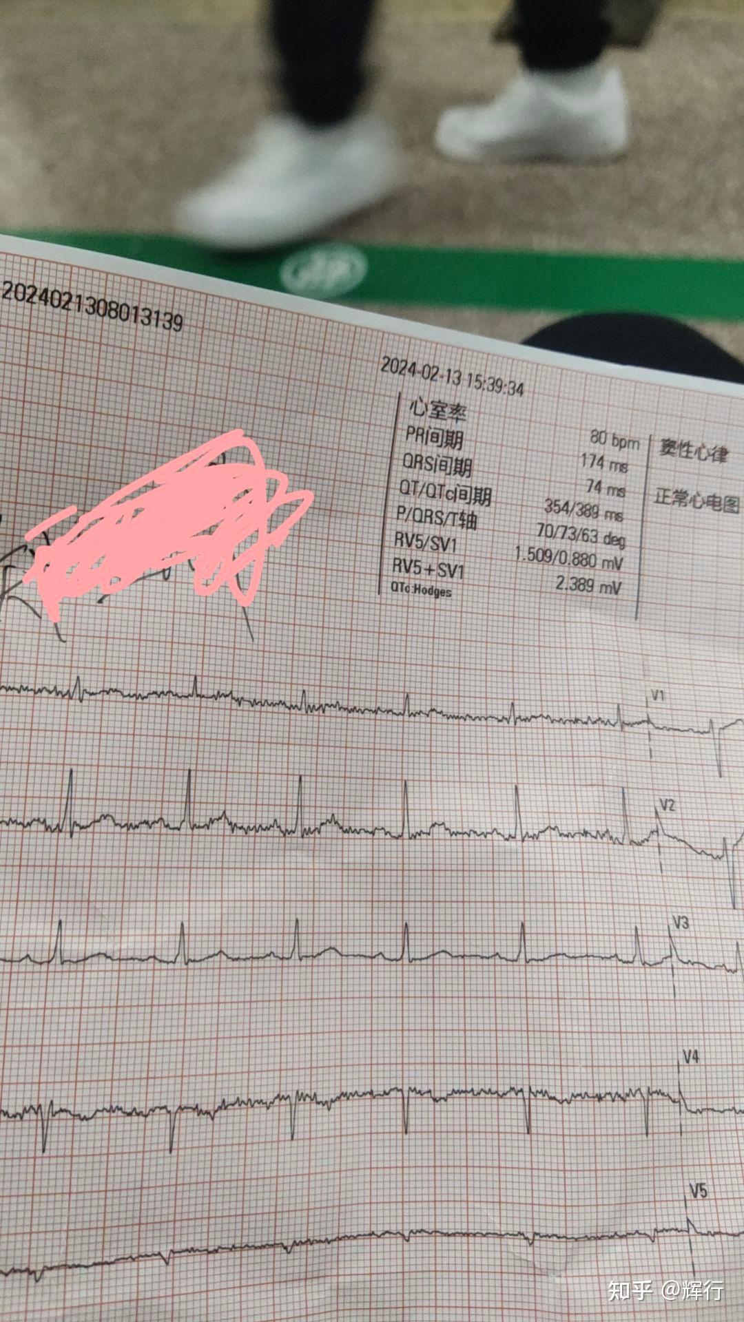 有一种眩晕是耳石症
