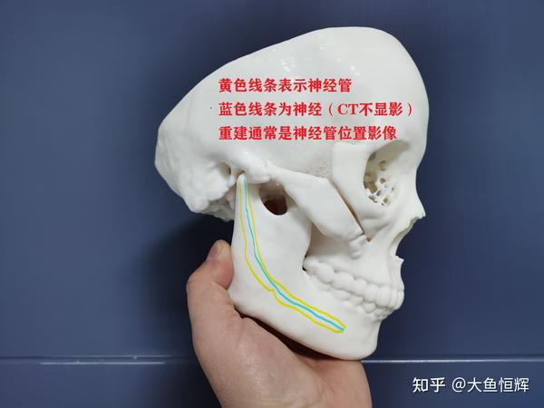 下牙槽神经重建打印模型在下颌角切除整形手术中的重要性分析 - 知乎