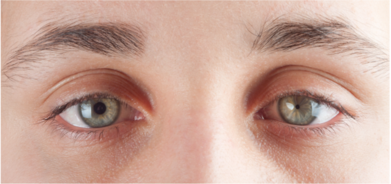 左为正常瞳孔,右为针尖样瞳孔,好不容易找到一张不吓人的图