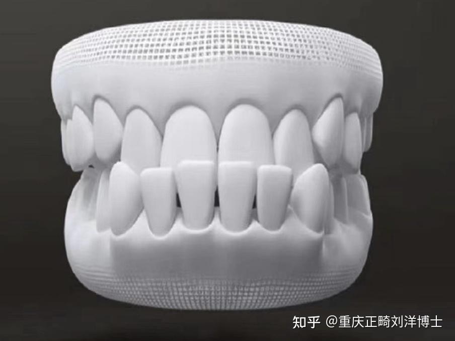 重庆正畸分享|如何解除个别牙反合(地包天)与牙列不齐? - 知乎