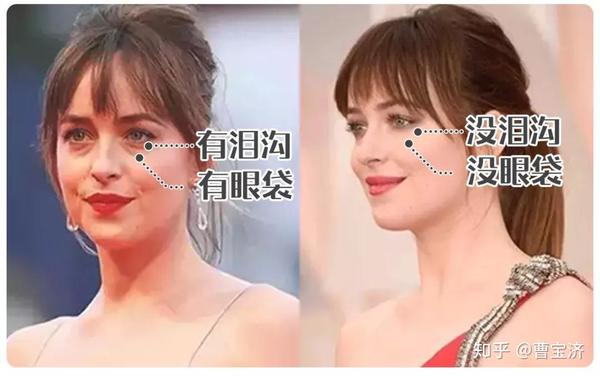 科普 | 泪沟类型分不清?难怪你的泪沟花了10年还去不掉 - 知乎