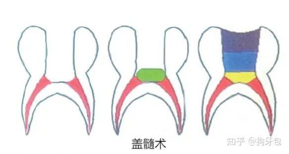 明明还有盖髓术,为什么牙医都只做根管治疗?因为根管更贵? - 知乎