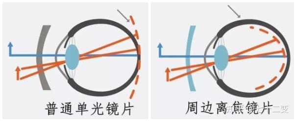 离焦镜到底是不是智商税?看完这篇经验分享就知道答案! - 知乎