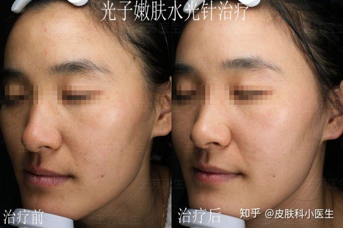 基础水光和光子嫩肤哪个好(光子嫩肤和水光一起做效果是不是更好)