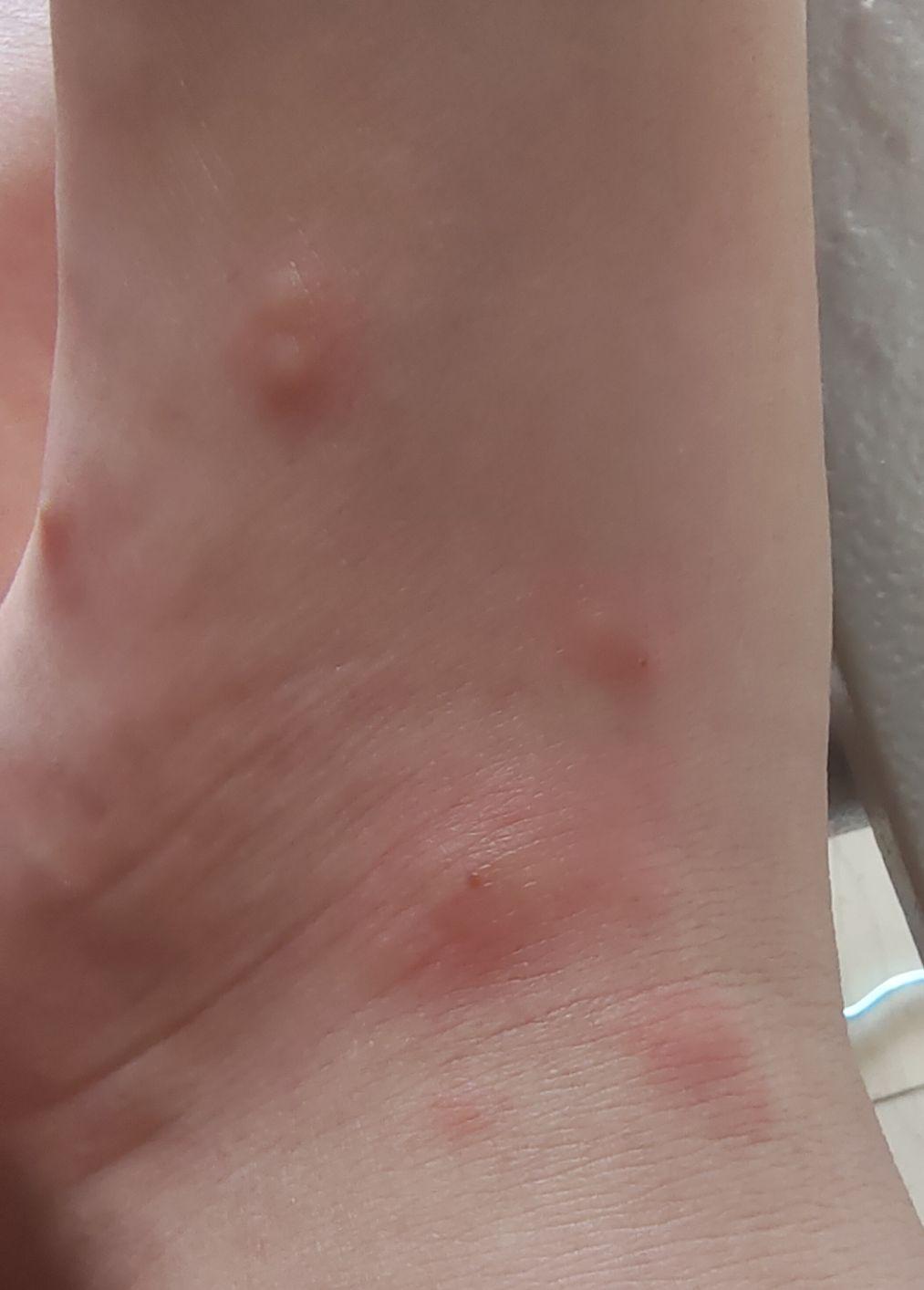 被蚂蚁咬之后用药什么更有效呢? - 知乎