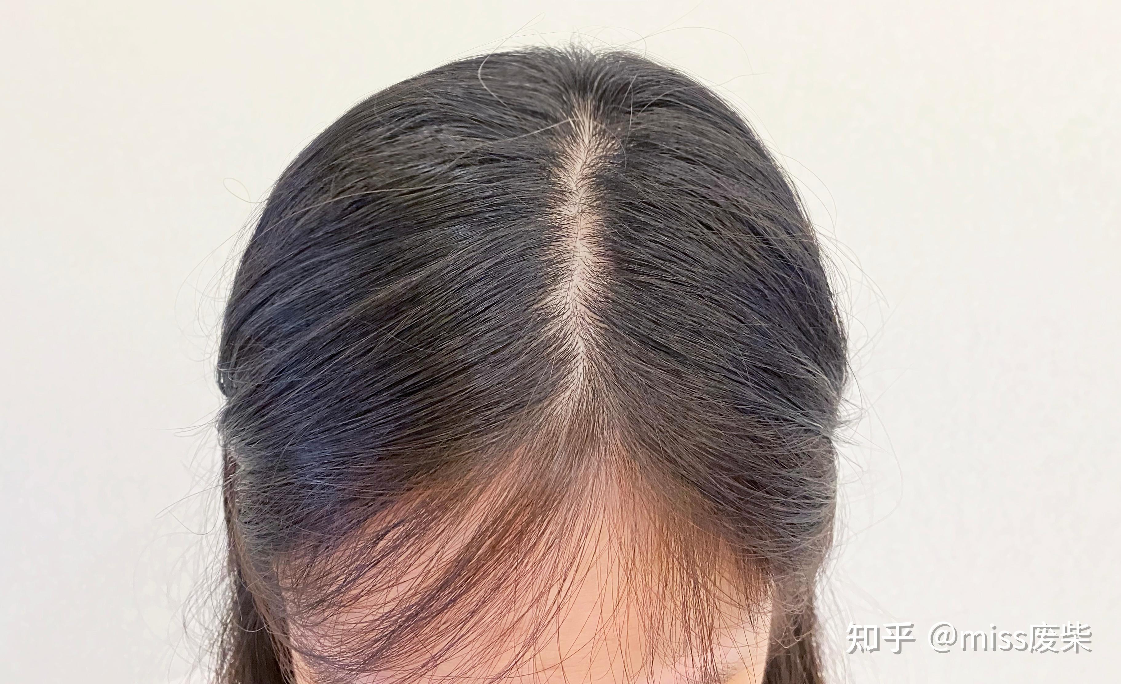 我与脱发的抗争史，如何挑洗发水才能有效缓解脱发？ - 知乎