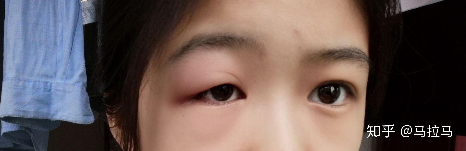 突然上眼皮就肿起来了而且又痛又痒眨眼都痛现在眼睛已经肿的特别厉害