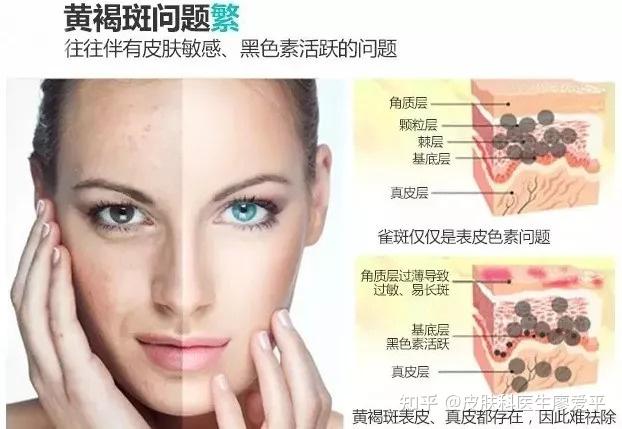 谁知道去掉面部黄褐斑最好的方法