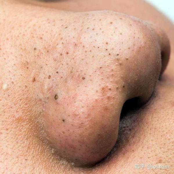 鼻子的黑头非常多非常大请问有什么办法可以把它除去