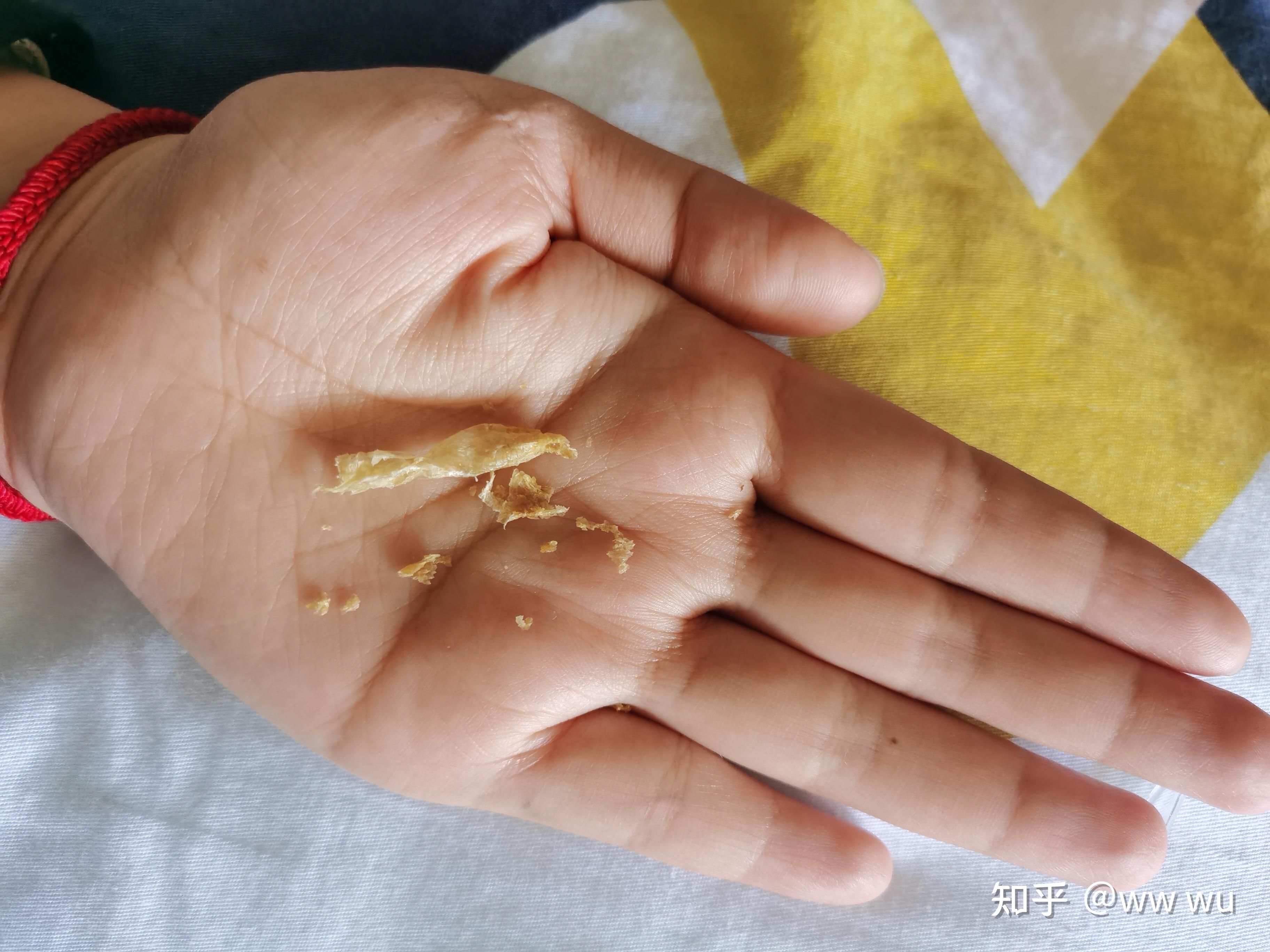 为什么我掏出来的耳屎是桶状的就是一层薄膜粘附在耳壁上