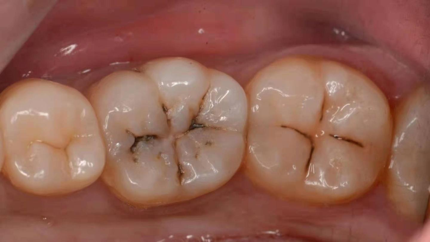 孩子牙齿黑斑的疗愈 | 安疗网