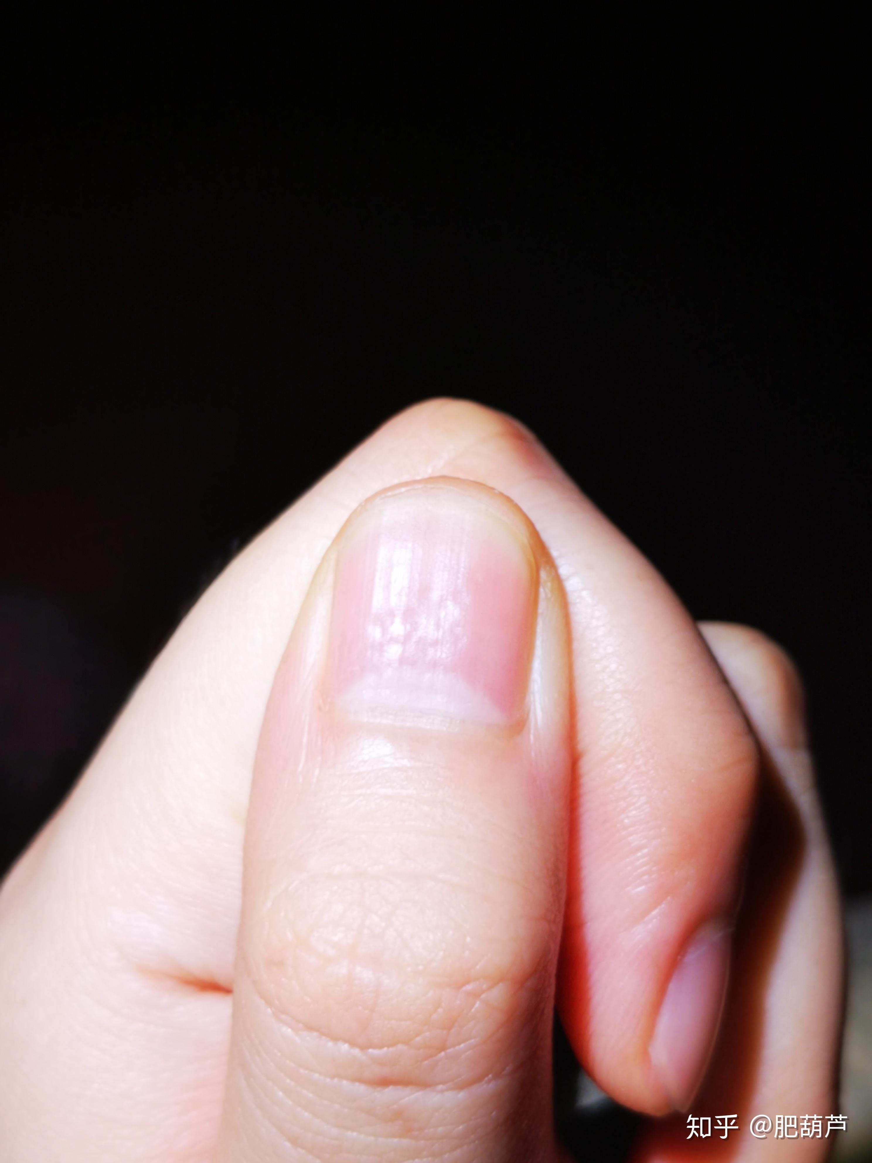 手指甲上全是小坑是怎么回事呢