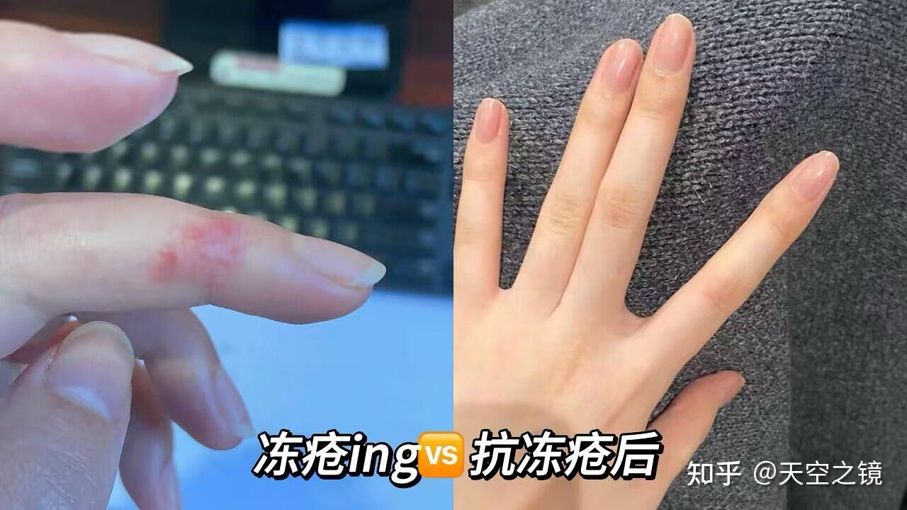 冻疮的病因和发病机制是什么? - 知乎