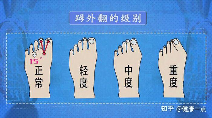 拇外翻的治疗方式有哪些,手术后可能面对什么风险,需要注意什么问题?