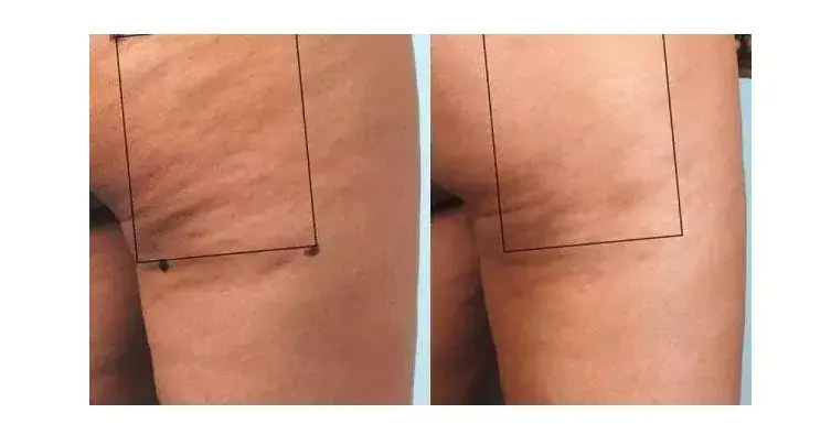 20岁左右身材不肥胖下半身居然也橘皮是什么原因