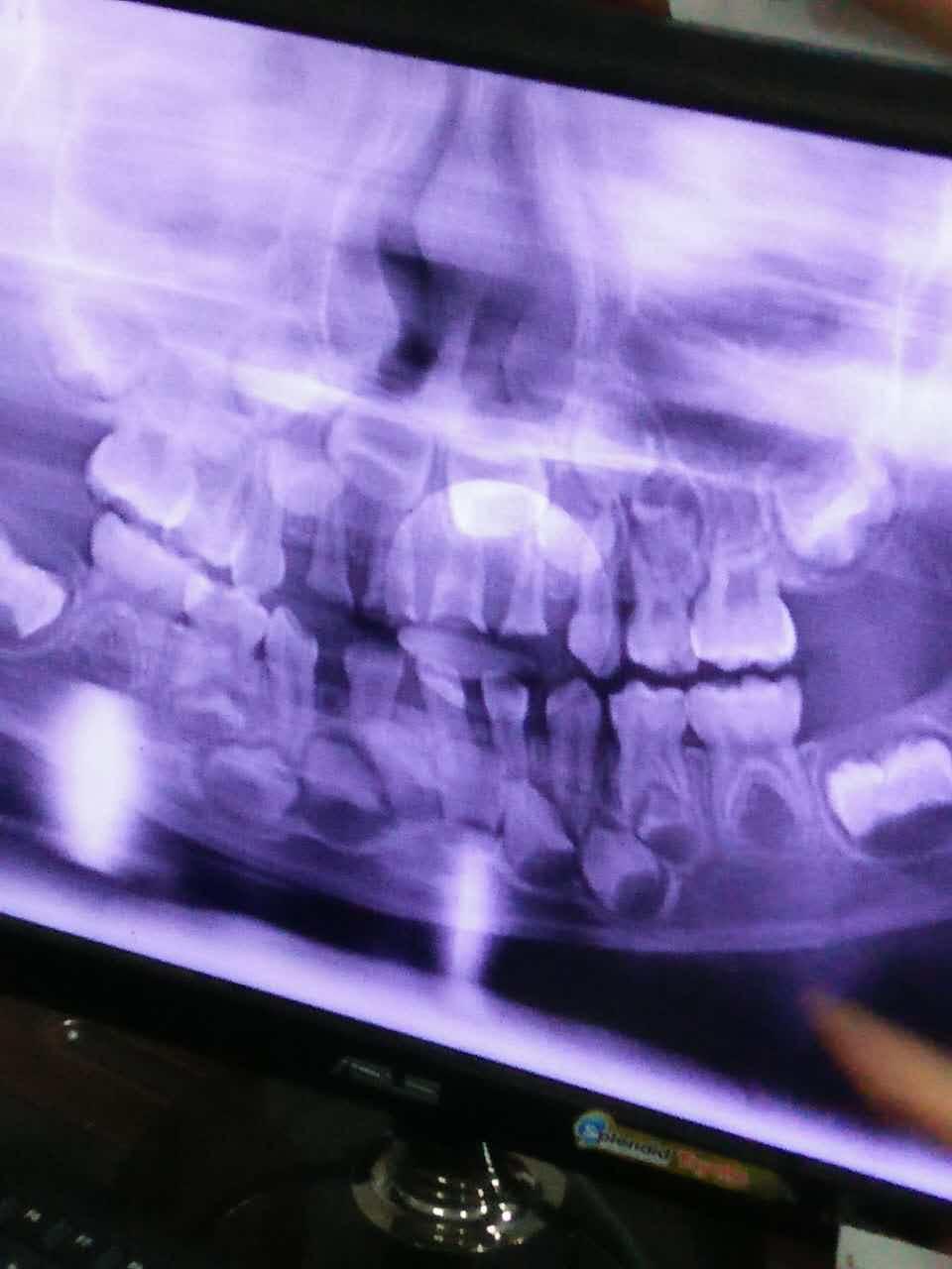 牙医碰见最烂的牙有多烂? - SHINeelion 的回答