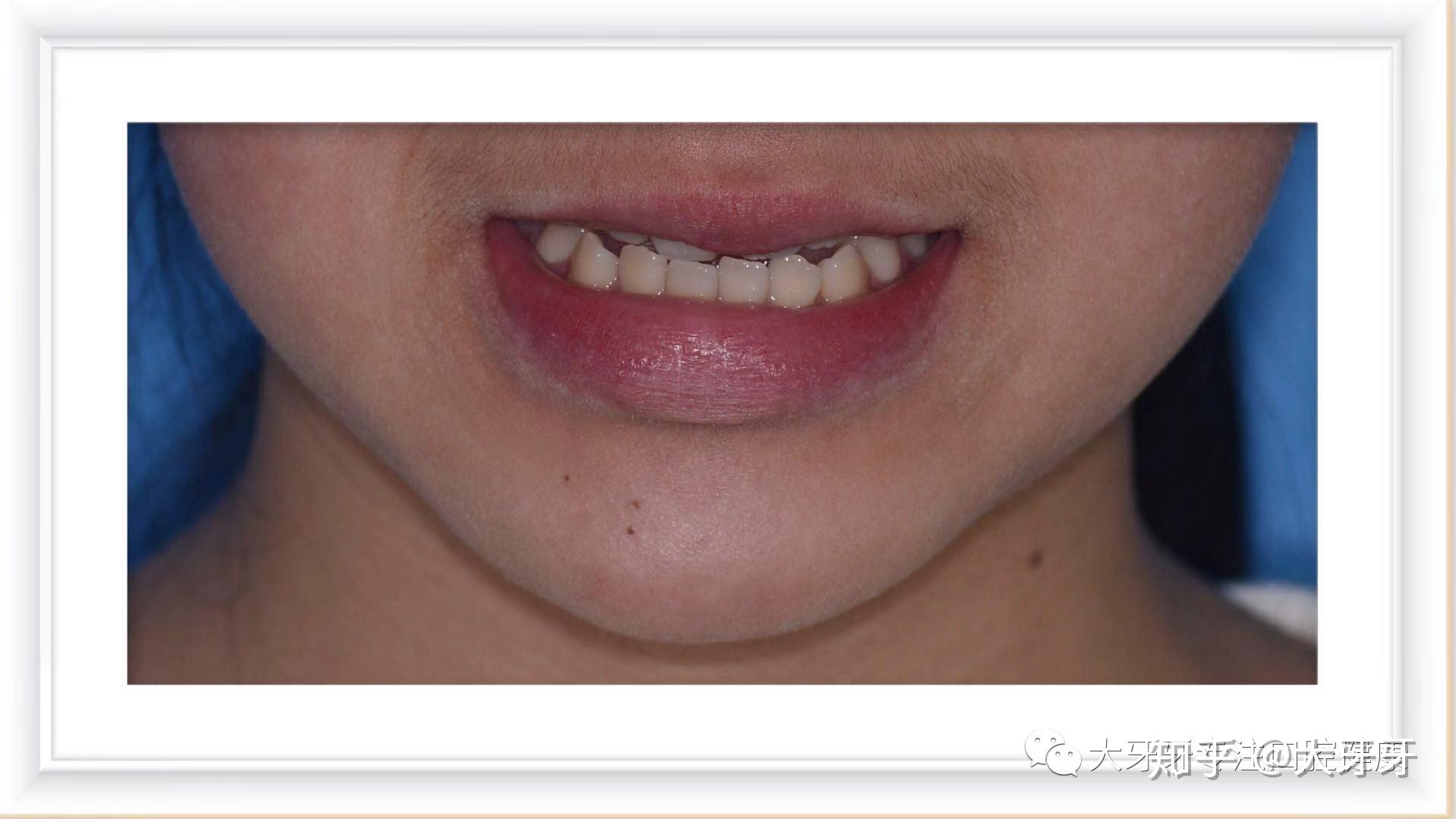 通常见于如下两类原因: 1,牙齿短:可以通过修复,正畸的方法进行解决