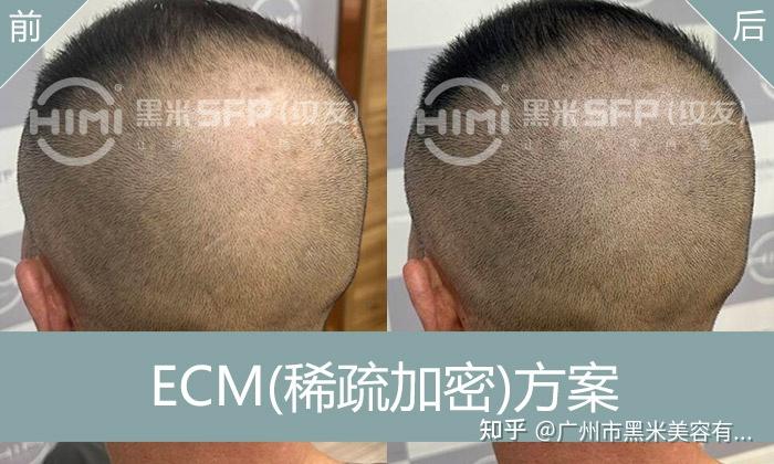 广州后脑勺加密纹发 - 知乎