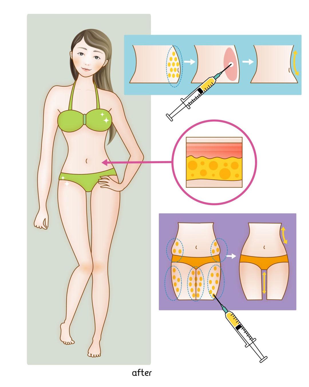(二)按照设计好的切开进行抽脂手术