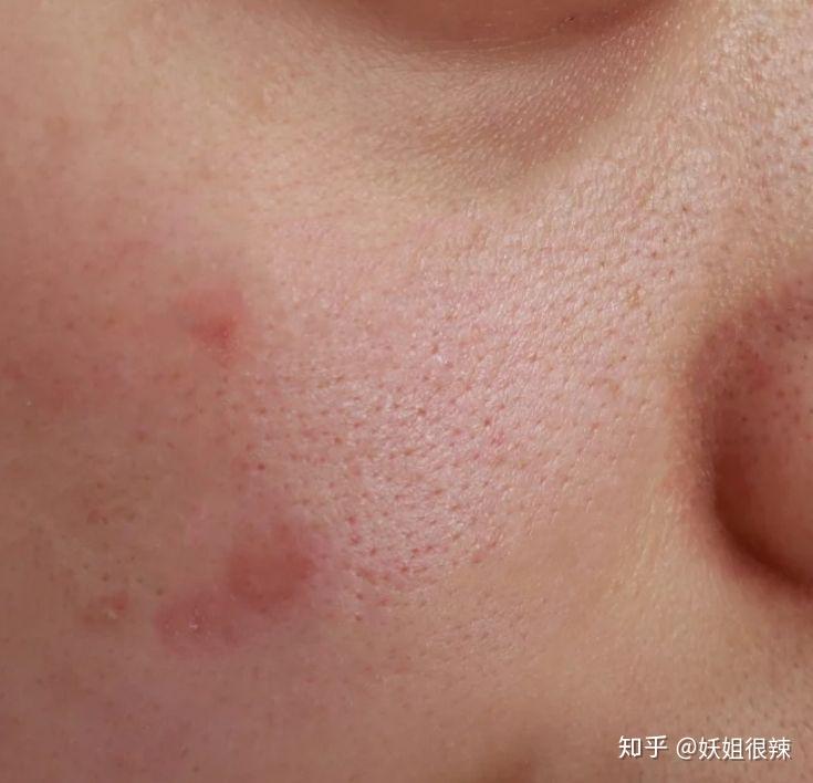 熬夜痘,姨妈痘痘,统统消光光!