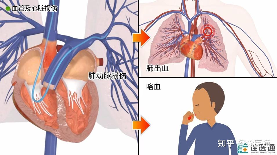 和你聊聊心导管检查那些事