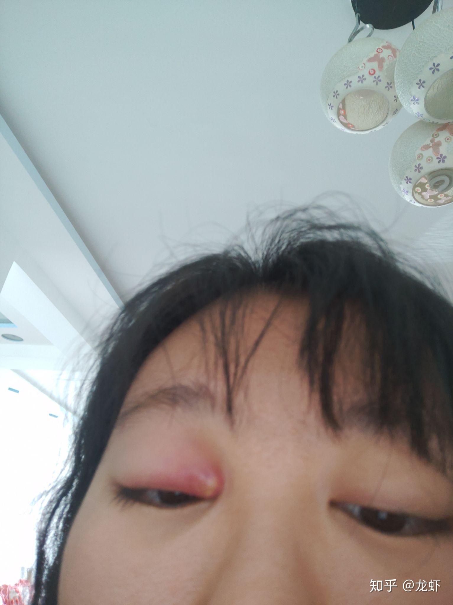 眼睛麦粒肿初期症状有哪些? - 知乎